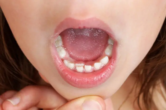 Aesthetic Improvement of Over-Retained Deciduous Canines